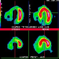 Coupes tomoscintigraphiques