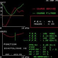 Fonction diastolique VG