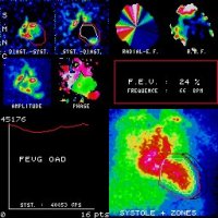 Fonction systolique VG en OAD