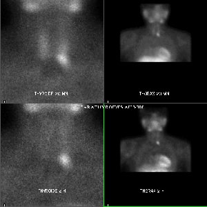 Scintigraphie des glandes parathyroïdes au MIBI