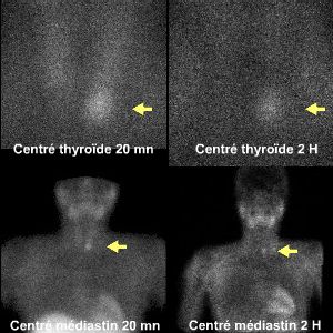 Scintigraphie des parathyroïdes au MIBI