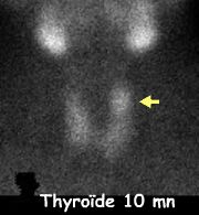 Centré thyroïde 10 mn