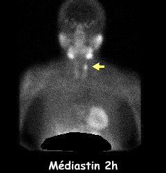 Centré médiastin 2 h