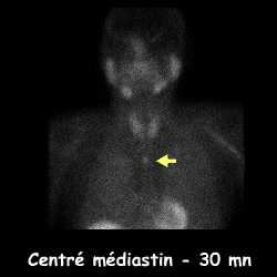 Centré médiastin - 30 mn