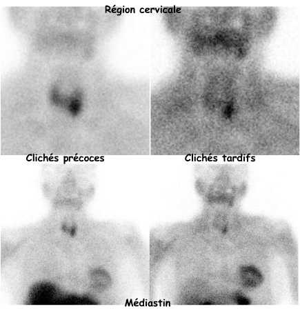 Clichés centrés précoces et tardifs