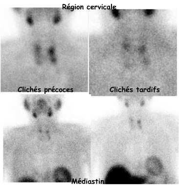 Clichés précoces et tardifs