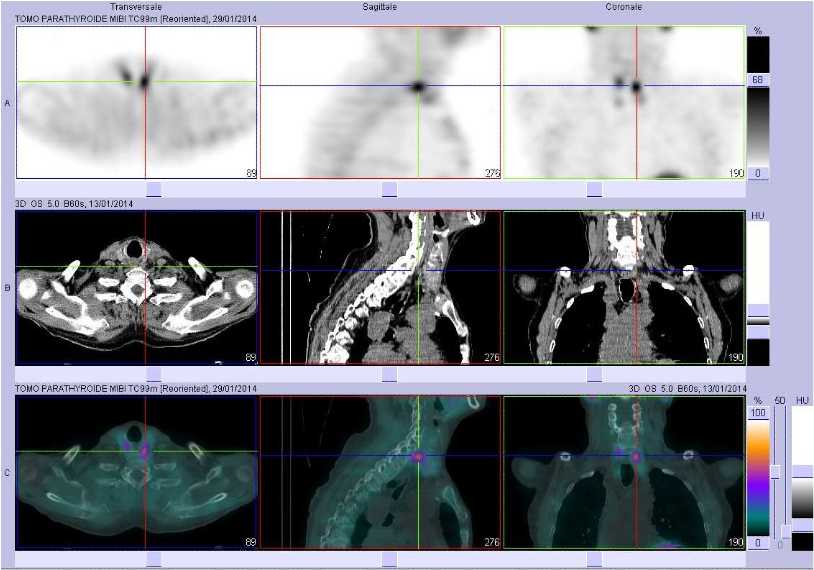 Hyperplasie des glandes parathyroïdes