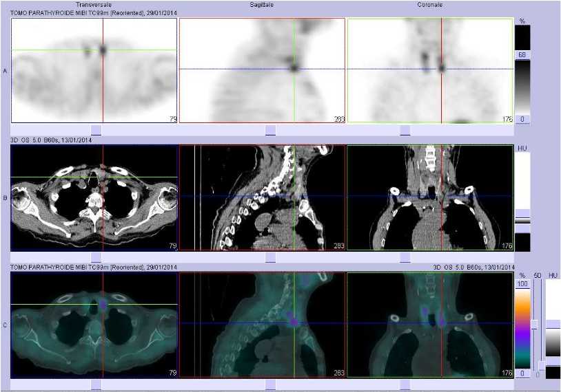 Hyperplasie des glandes parathyroïdes