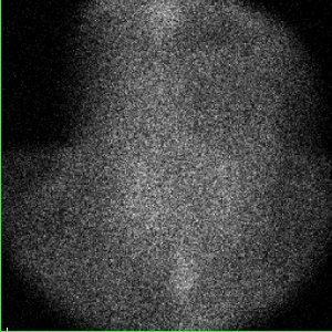 Scintigraphie thyroïdienne au Tc 99m