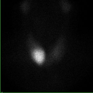 Scintigraphie thyroïdienne au Tc 99m