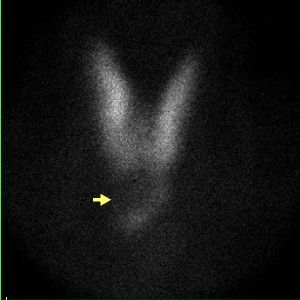 Scintigraphie thyroïdienne au Tc 99m