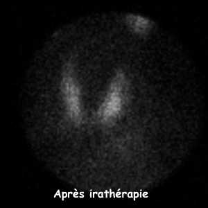 Disparition du nodule chaud après radiothérapie métabolique