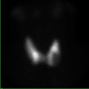 Scintigraphie thyroïdienne au Tc 99m