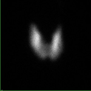 Scintigraphie thyroïdienne à l'Iode 123