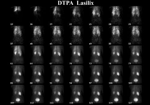 Scintigraphie rénale au DTPA sensibilisée par le Lasilix®