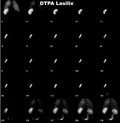 DTPA Lasilix