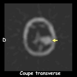 Tomoscintigraphie - Coupe transverse
