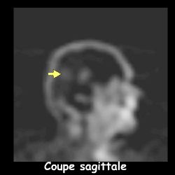 Tomoscintigraphie - Coupe sagittale