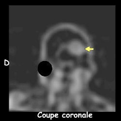 Tomoscontigraphie - Coupe coronale