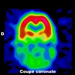 Coupe coronale