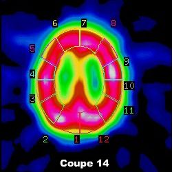 Quantification coupe 14