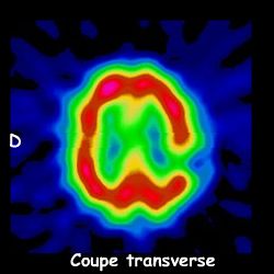 Tomoscintigraphie - Coupe transverse