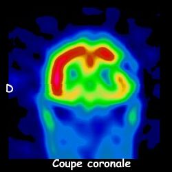 Tomoscontigraphie - Coupe coronale