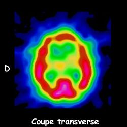 Tomoscintigraphie - Coupe transverse