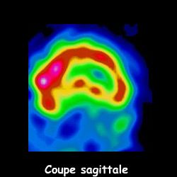 Tomoscintigraphie - Coupe sagittale