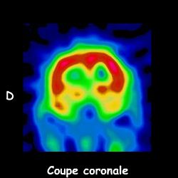 Tomoscintigraphie - Coupe coronale