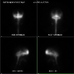 Cisternographie isotopique - 5 ème heure