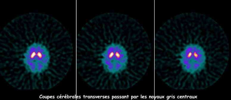 Syndrome extra-pyramidal lié aux neuroleptiques