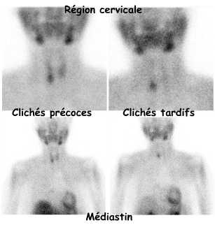 Adénome parathyroïdien