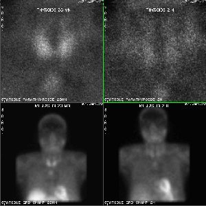 Scintigraphie des glandes parathyroïdes au MIBI