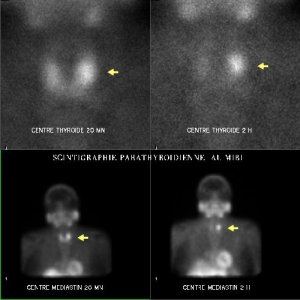 Scintigraphie des glandes parathyroïdes au MIBI