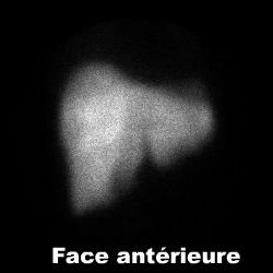 Scintigraphie hépatique - face antérieure