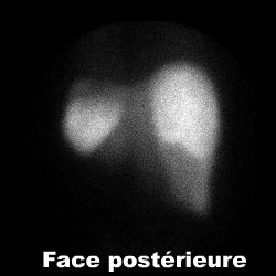 Scintigraphie hépatique - Face postérieure