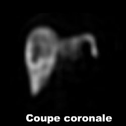 Tomoscintigraphie hépatique - Coupe coronale