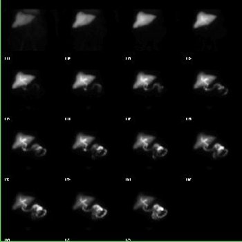 Scintigraphie hépato-biliaire - dynamique 60 mn