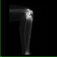 Temps osseux - Profil externe genou droit