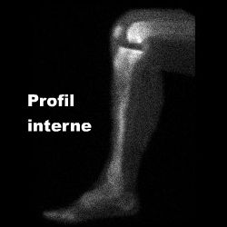 Temps osseux - Profil interne
