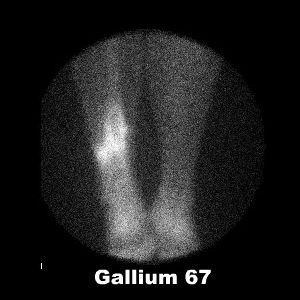 Scintigraphie au Gallium 67