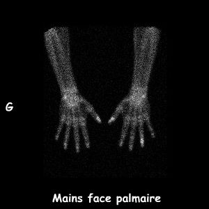 Mains incidence palmaire