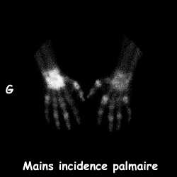 Mains - Incidence palmaire