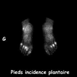 Pieds - Incidence plantaire