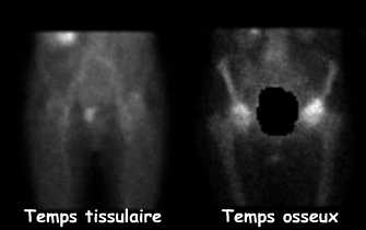 Hanches - Temps tissulaire et temps osseux