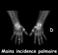 Arthrites des peites articulations des deux mains
