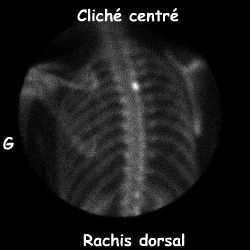Rachis dorsal - Incidence postérieure