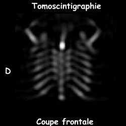 Tomoscintigraphie - Coupe frontale