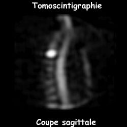 Tomoscintigraphie - Coupe sagittale